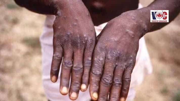 Monkeypox cases rise in Sindh as Karachi reports second infection
